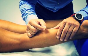 dry needling